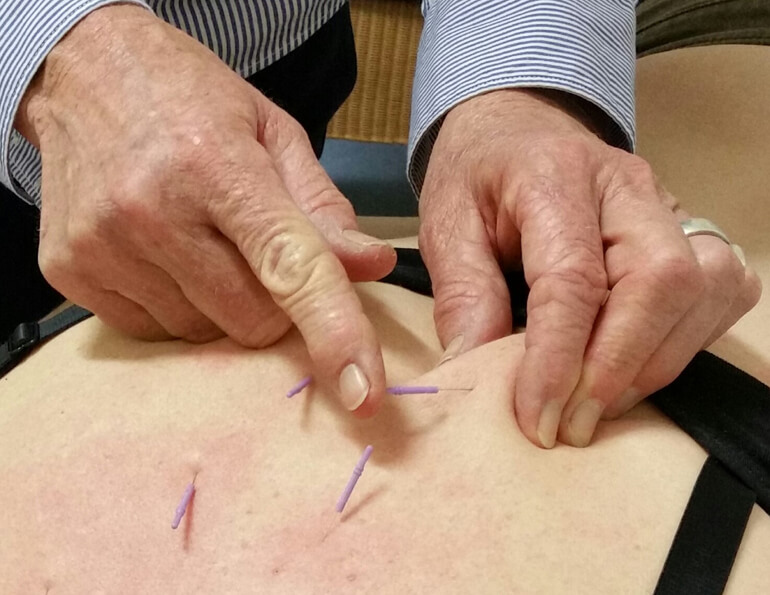 Dry needling Adelaide  