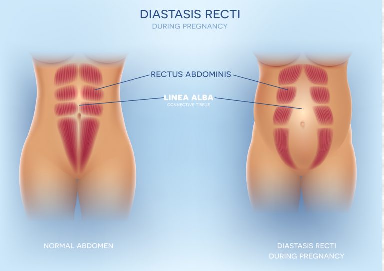 diastasis recti image