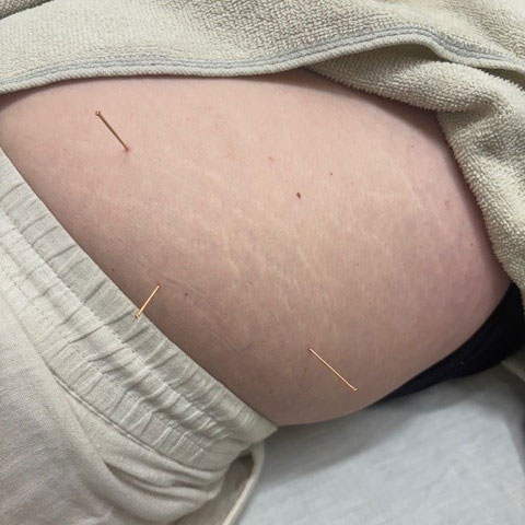 Dry needling Adelaide  
