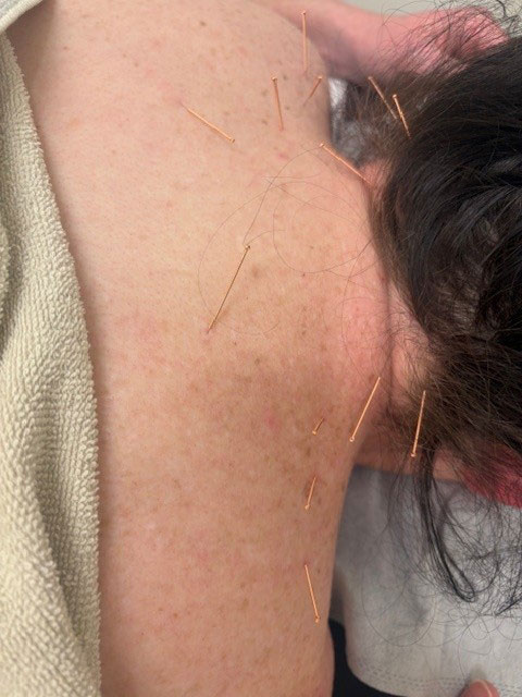 Dry needling Adelaide  
